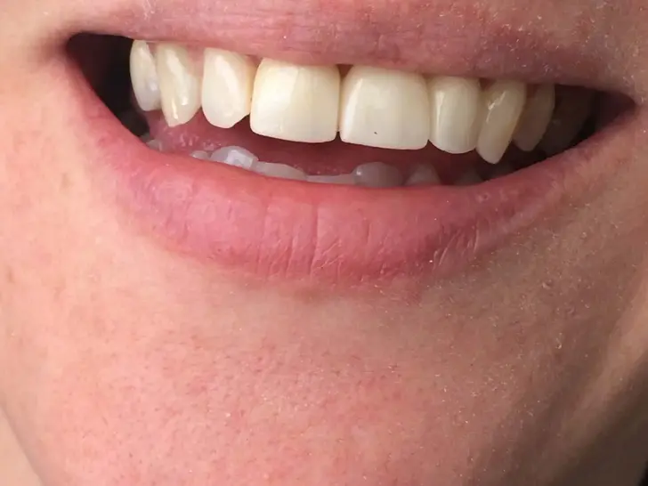 After: Emax ceramic crowns